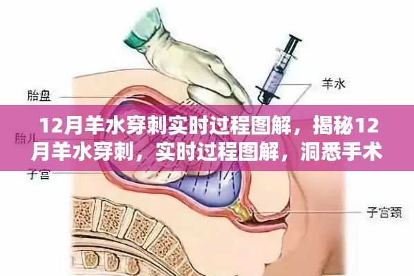 揭秘，12月羊水穿刺全过程图解，洞悉手术细节与实时操作过程